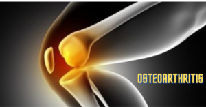 Read more about the article Osteoarthritis -A Joint problem