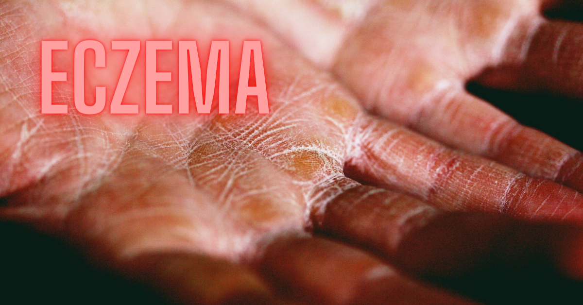 You are currently viewing Eczema-An Ayurvedic Approach