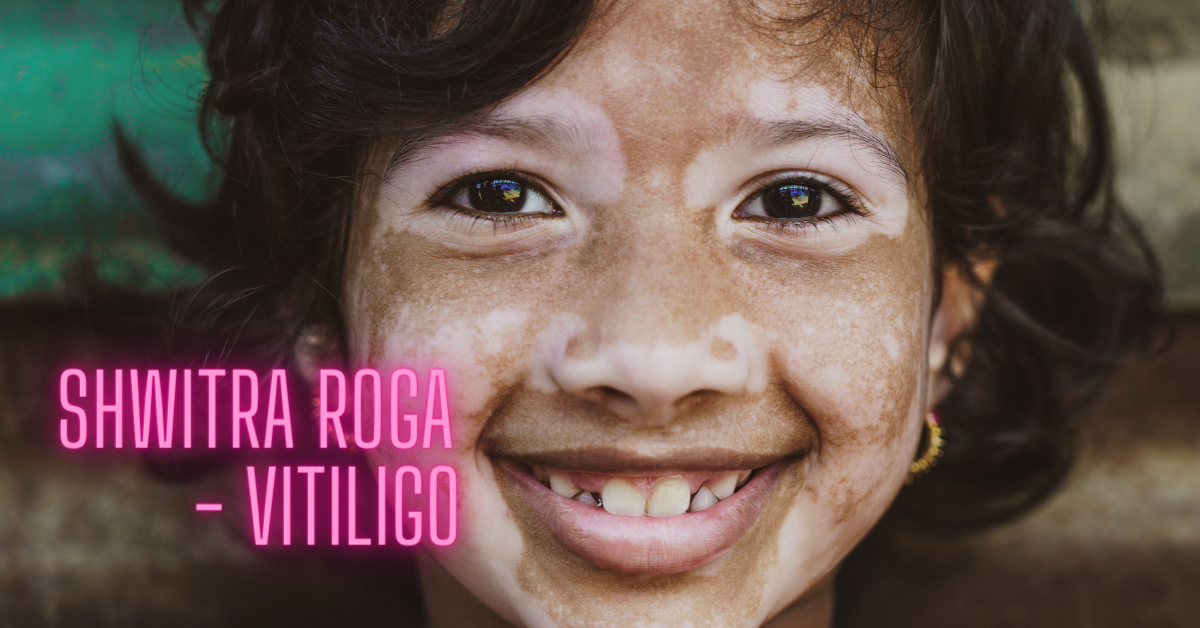 Read more about the article Shwitra Roga – Vitiligo