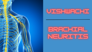 Read more about the article Vishwachi – Brachial neuritis 